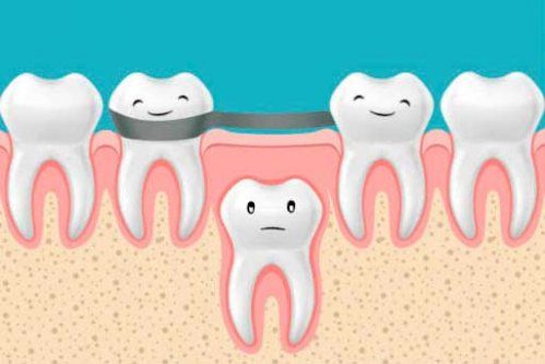 ¿Qué son los mantenedores de espacio?